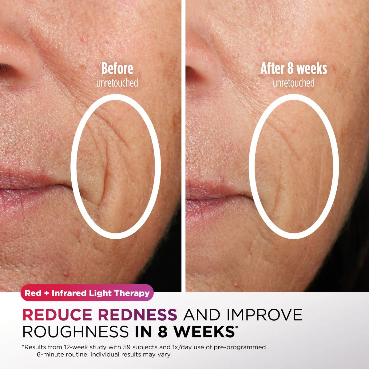 Shark CryoGlow Under-Eye Cooling & LED Anti-Ageing & Blemish Repair Mask Lilac Chill SAVE 30 - Image 7